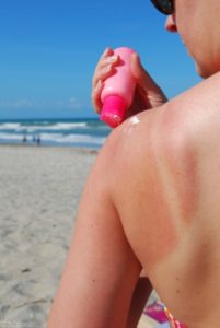 A third of sunburn cases happen in the UK